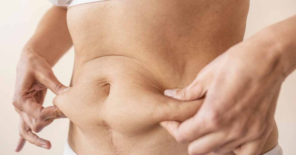 Conheça os protocolos mais eficientes para combater a Flacidez Abdominal
